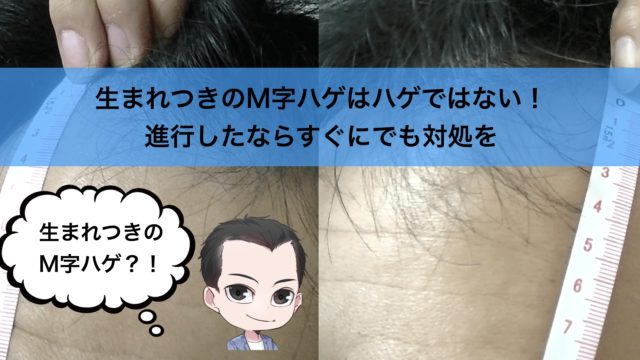 生まれつきのm字ハゲはハゲではない 進行したならすぐにでも対処を 若ハゲのモテ道