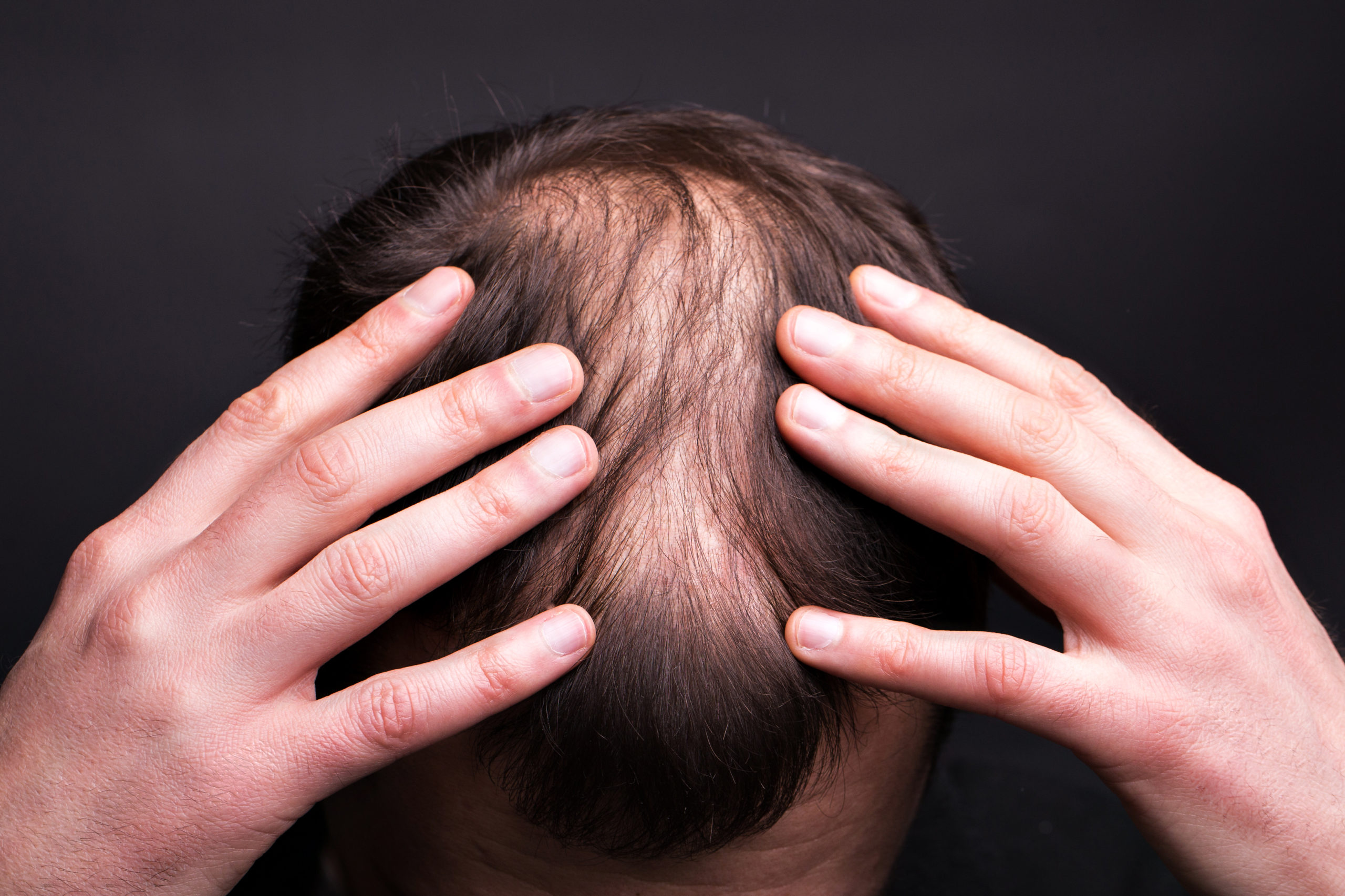 体験談 30代男性が湯シャンを3ヶ月続けた結果 抜け毛の改善は 若ハゲのモテ道